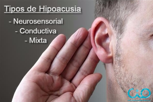 hipoacusia-cio-bilbao-tipos