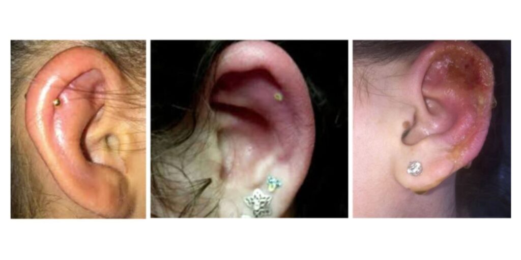 riesgos piercing cartíago