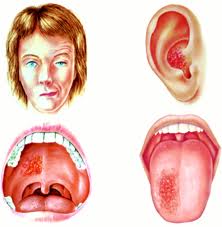 herpes zóster ótico