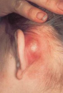 síntomas de la mastoiditis