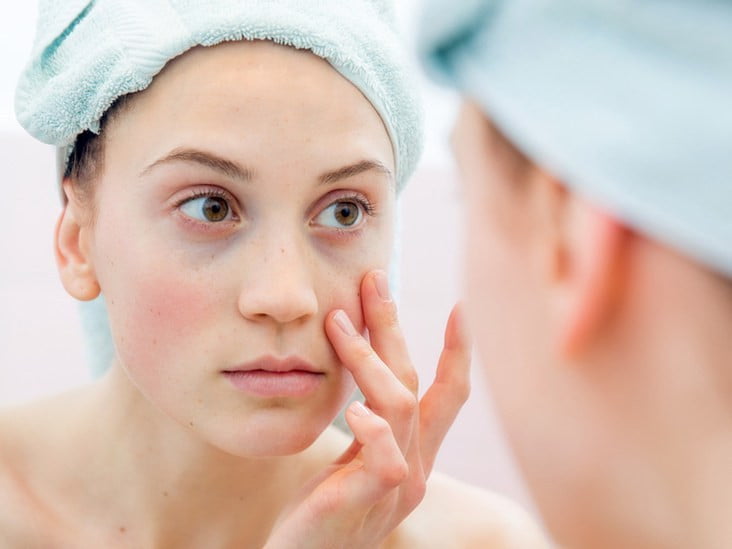 caída pelo lupus eritematoso cutáneo