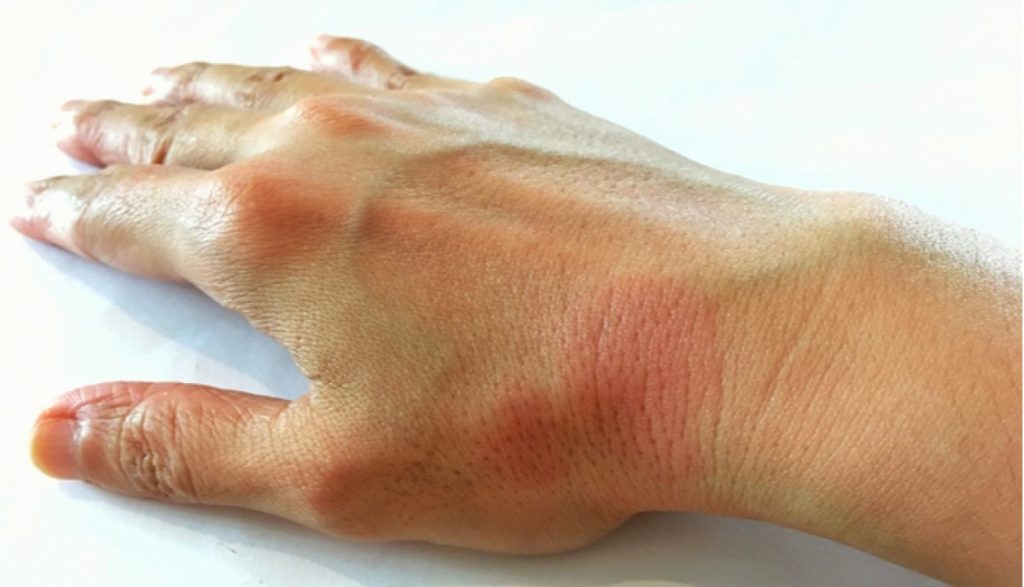 síntomas lupus eritematosos cutáneo