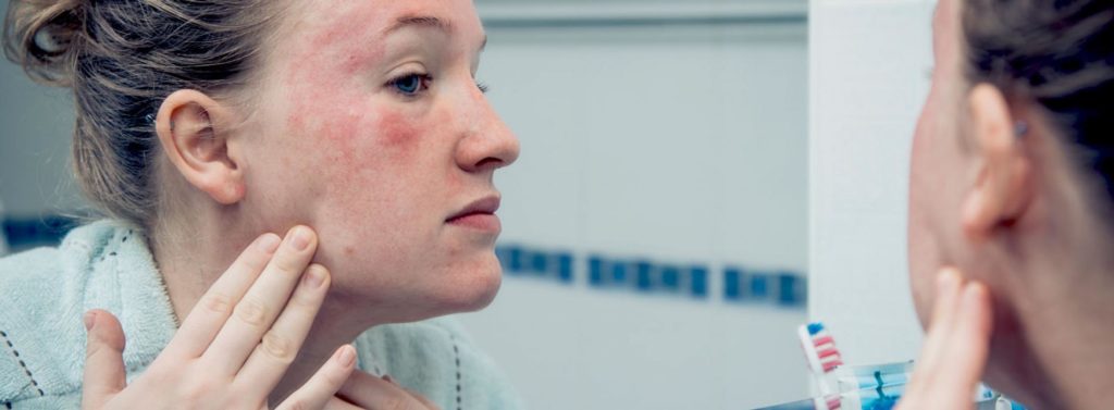 tratamiento lupus eritematoso cutáneo