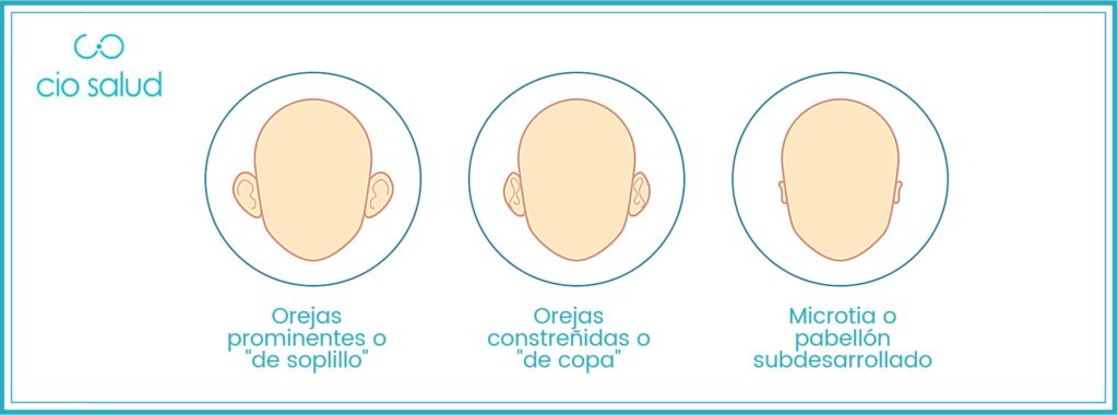 indicaciones de la otoplastia