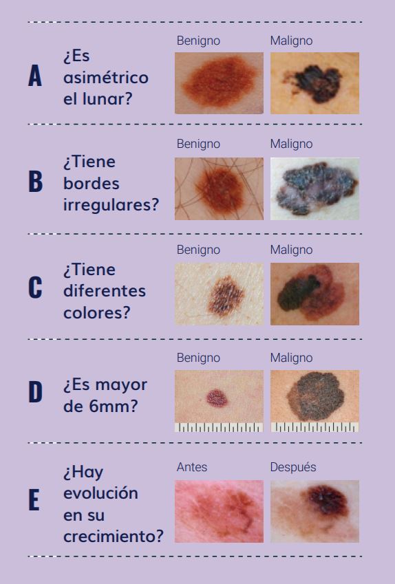 La regla del ABCD de los lunares
