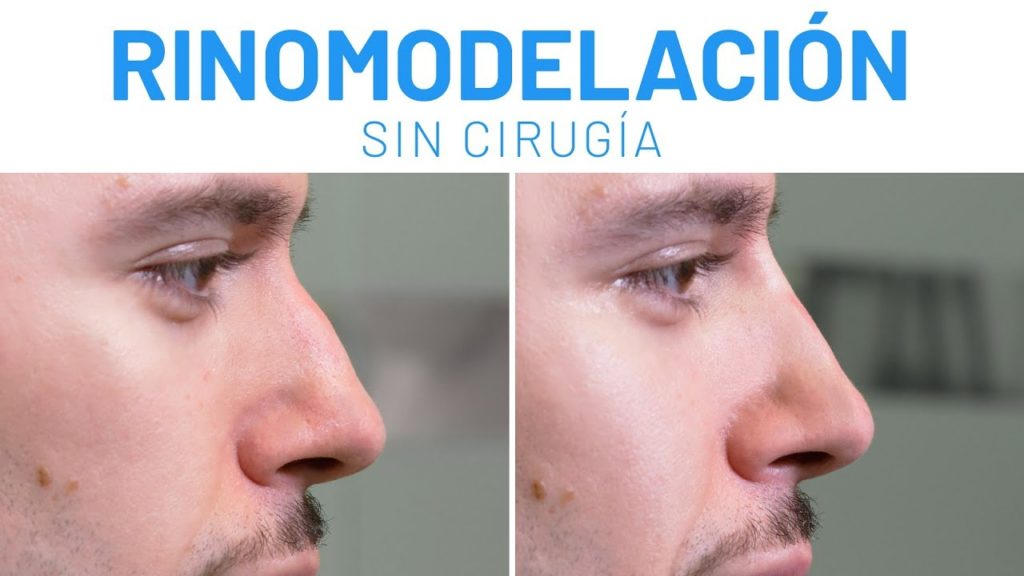 rinomodelación sin cirugía