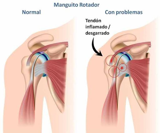 tendinitis hombro pádel