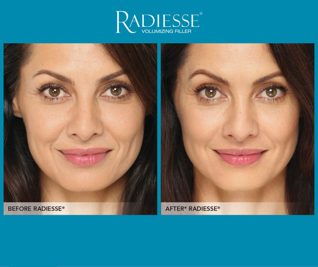 efecto lifting medicina estética