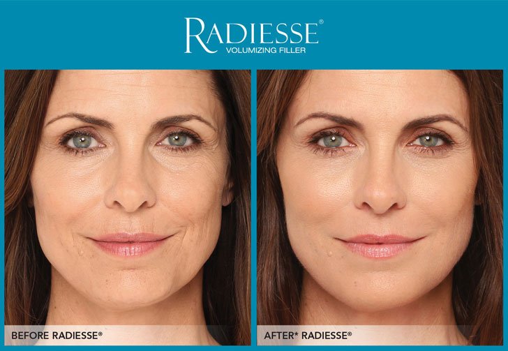 radiesse lifting facial