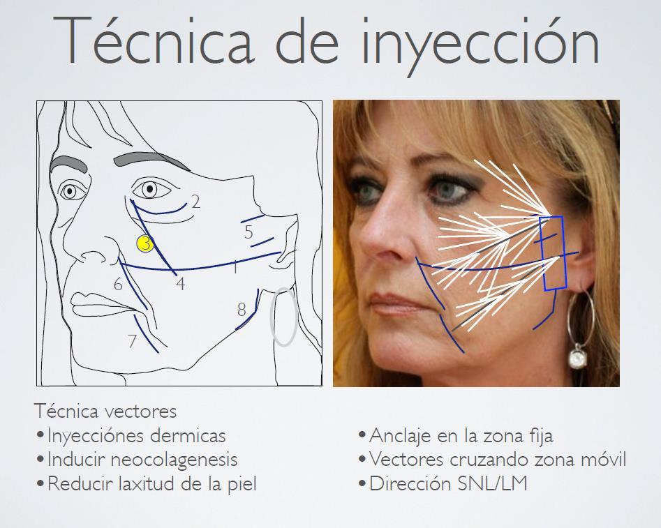 tratamiento radiesse facial