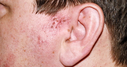 tratamiento herpes otico