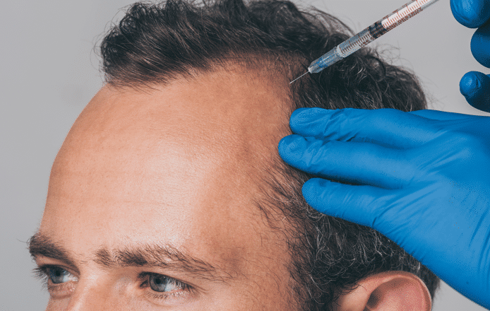 inyecciones para la alopecia