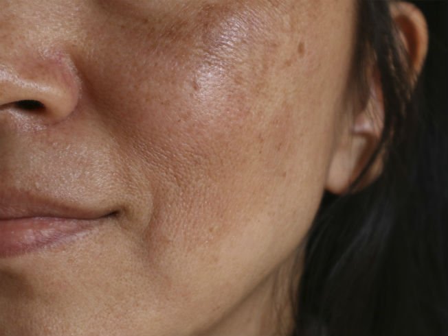 peeling facial manchas