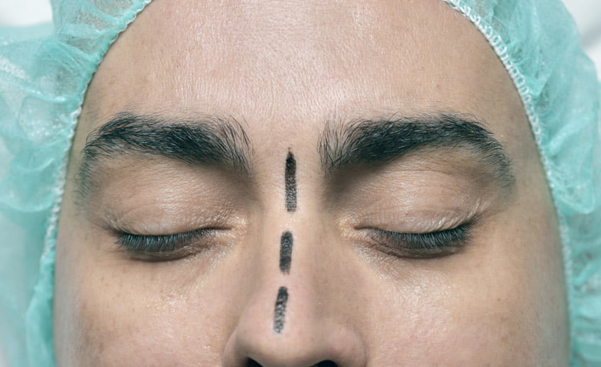 rinoplastia por malformación de nariz