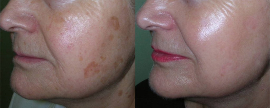 tratamiento eliminar manchas faciales