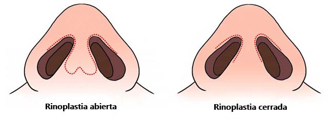 qué es mejor rinoplastia abierta o cerrada