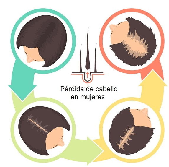 causas alopecia femenina