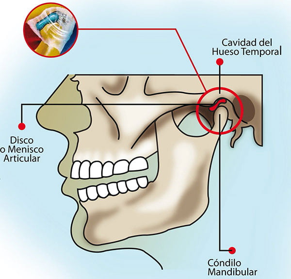 qué es el menisco mandibular