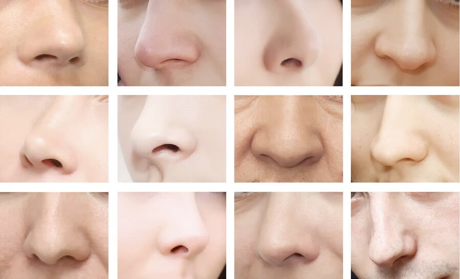 tipos nariz rinoplastia Bilbao