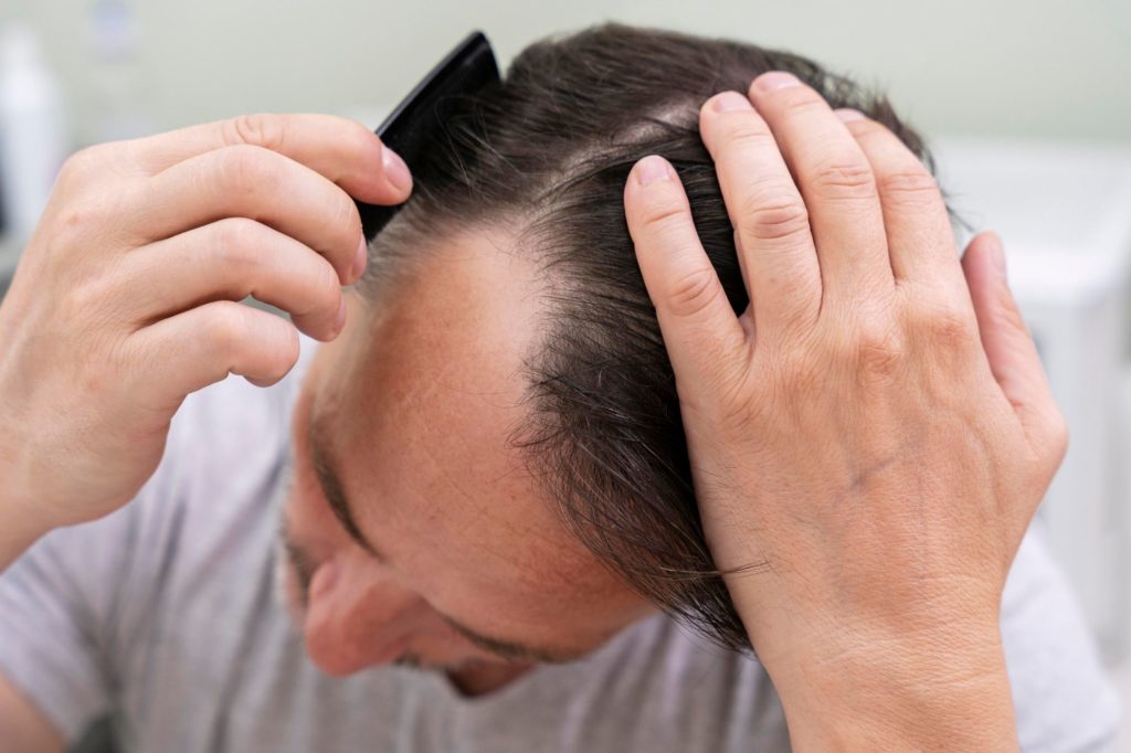 caída del pelo en hombres