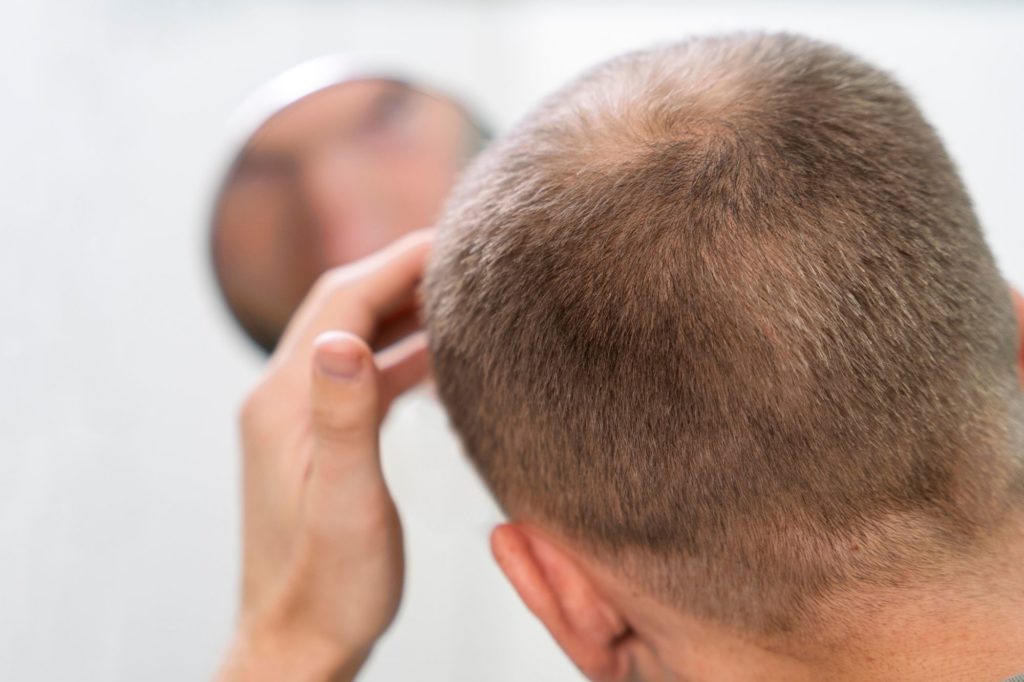 causas de la alopecia