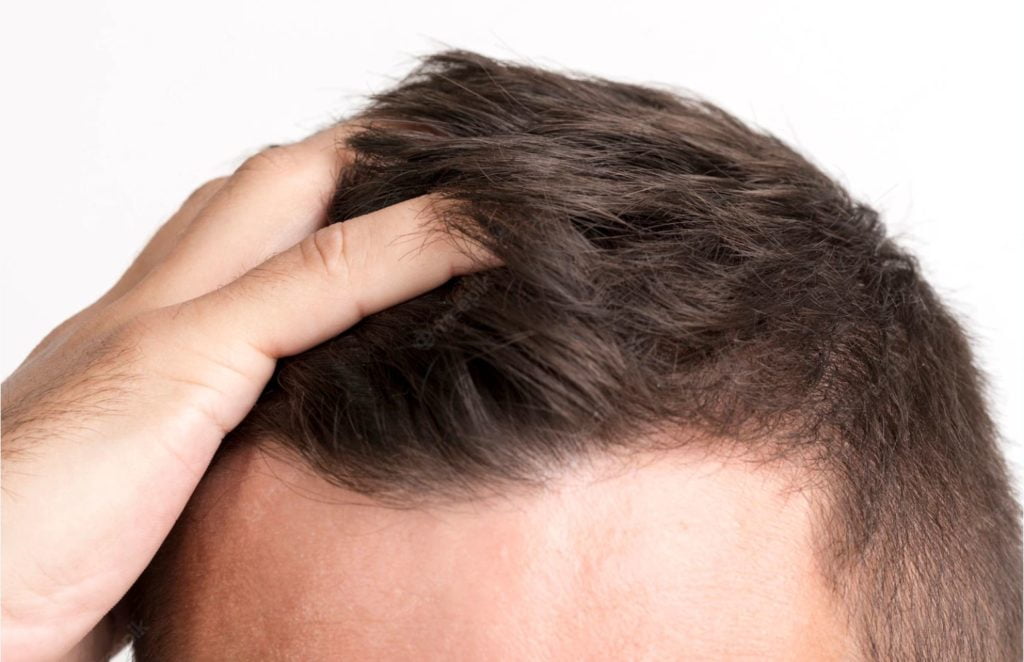 tratamiento para la caída del pelo
