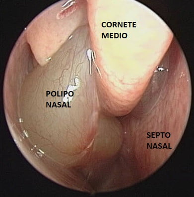 qué es un pólipo nasal
