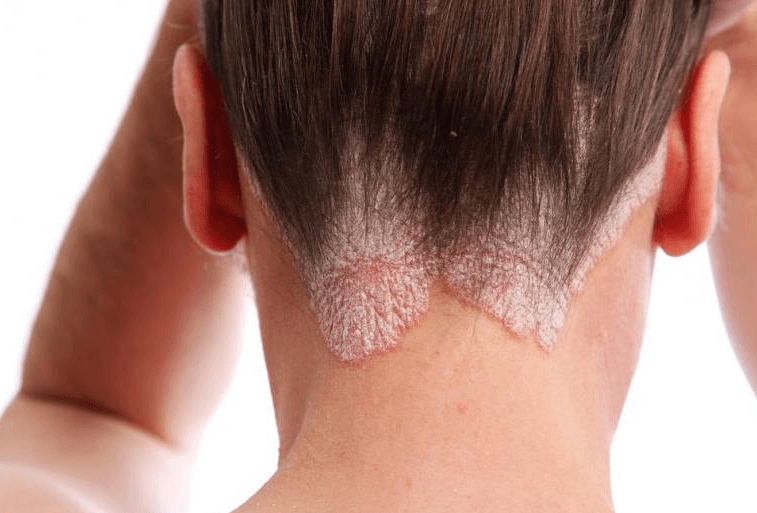causas de la dermatitis seborreica
