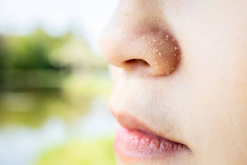 cremas para dermatitis seborreica