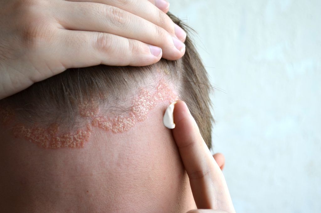 remedios caseros dermatitis seborreica