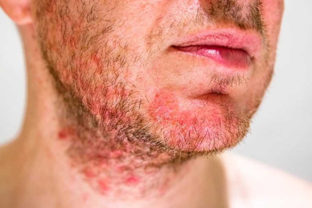 tratamiento dermatitis seborreica