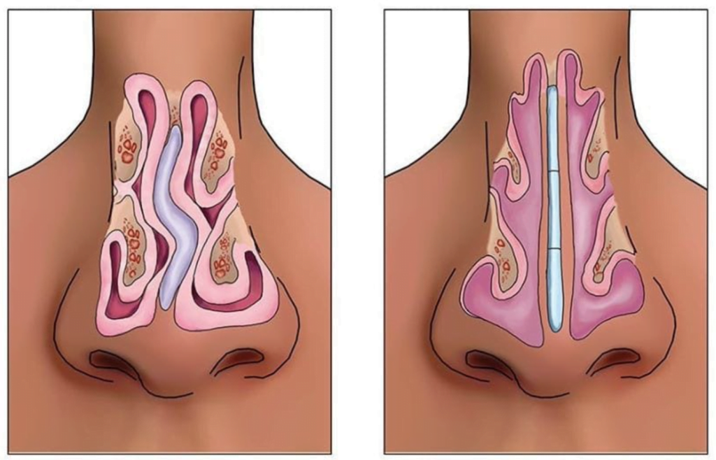 septoplastia tabique nariz desviado