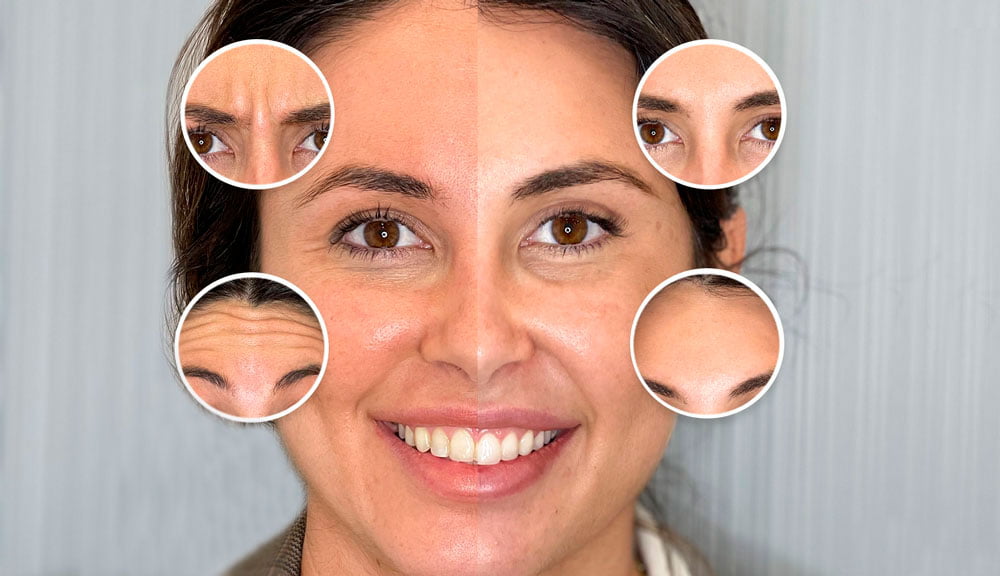 parálisis facial por bótox