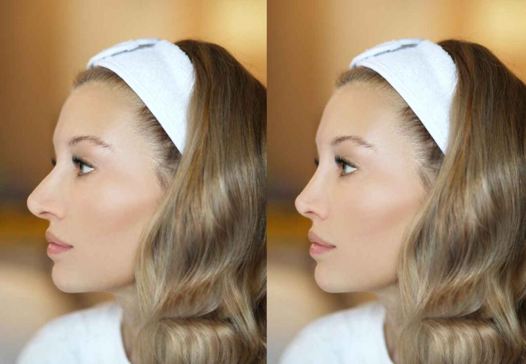 Rinoplastia antes y después nariz grande