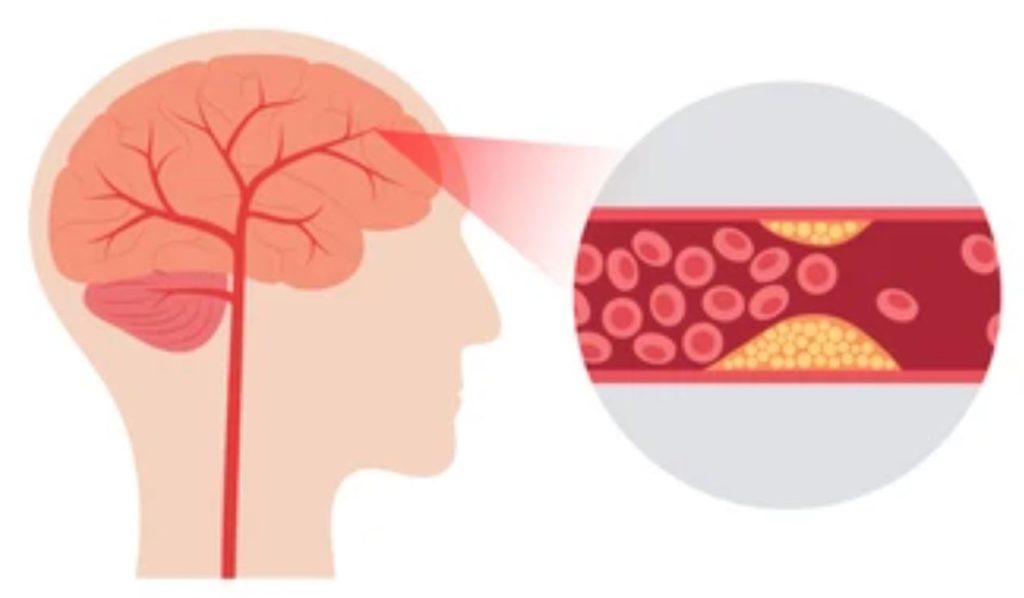isquemia cerebral