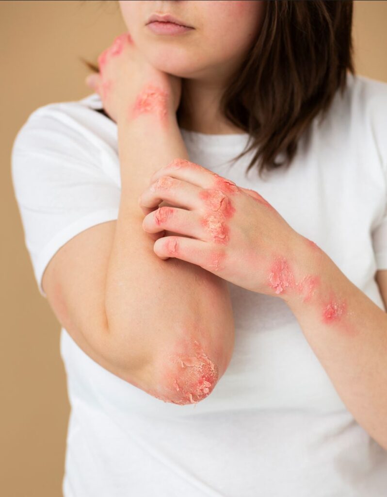 causas de la psoriasis
