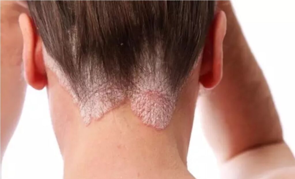 psoriasis pelo