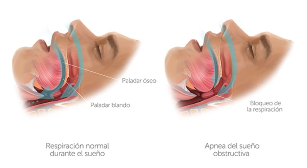 Apnea del sueño