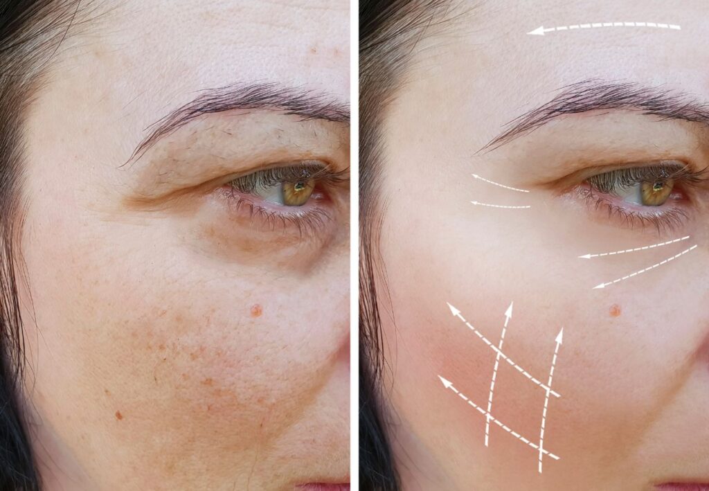 PDT facial