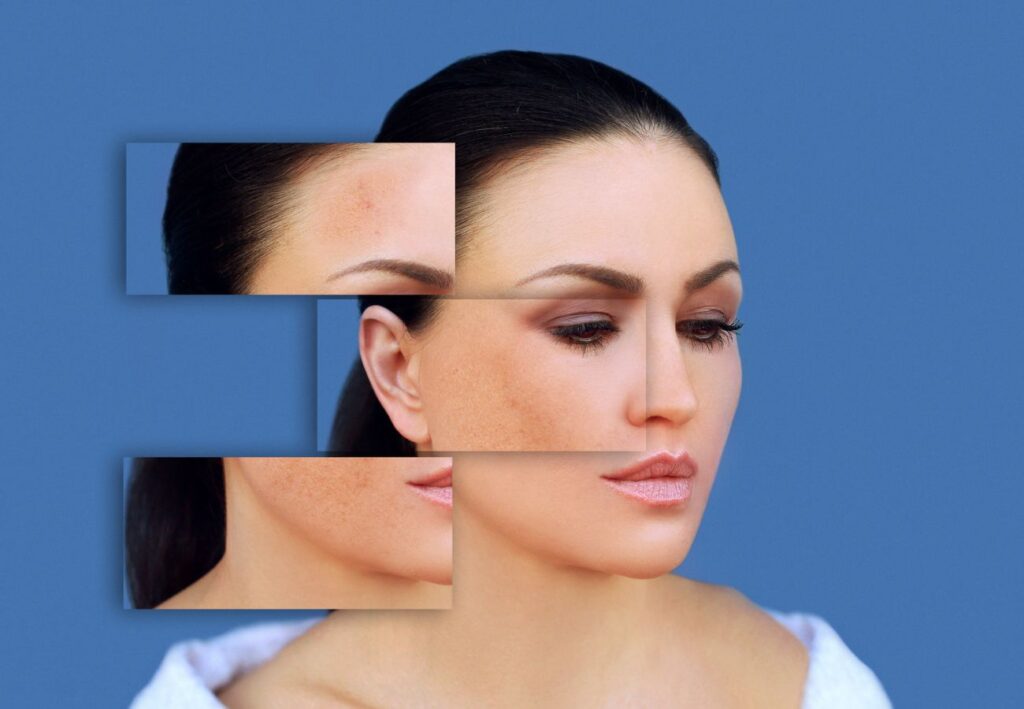 cremas para el melasma