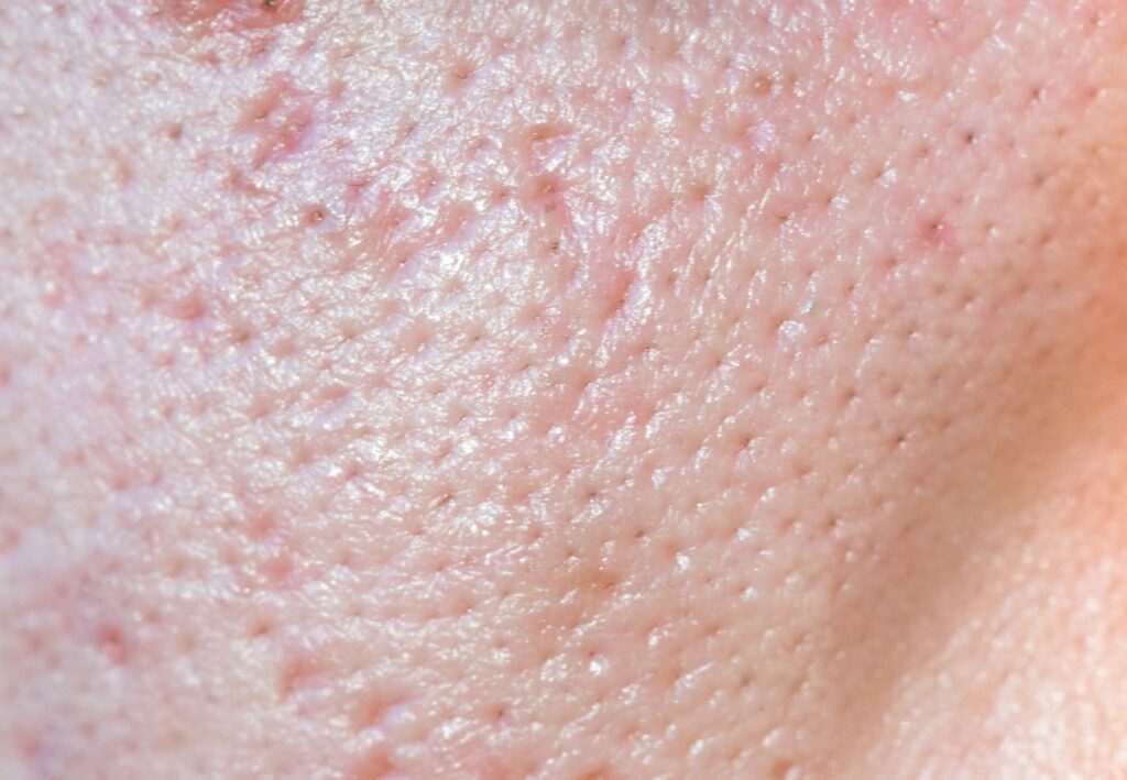 piel grasa