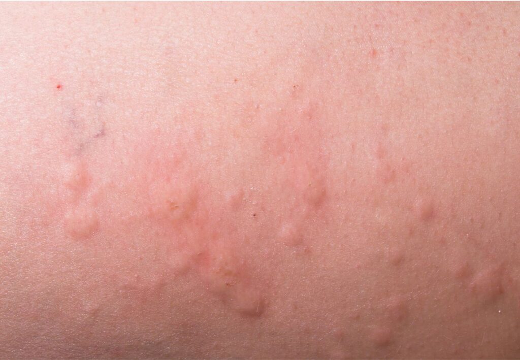 alergias piel bebés