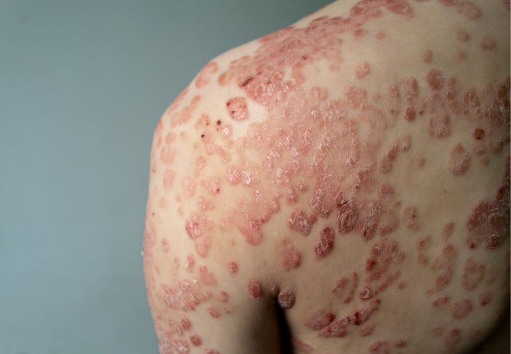 psoriasis
