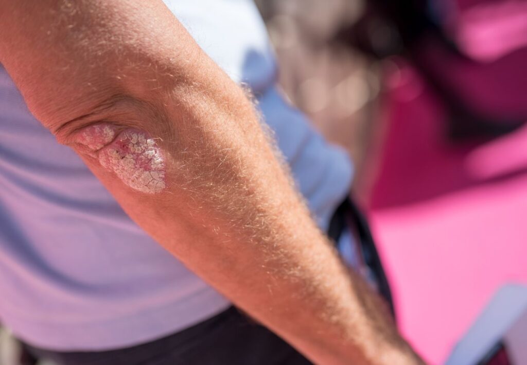 psoriasis escamosa