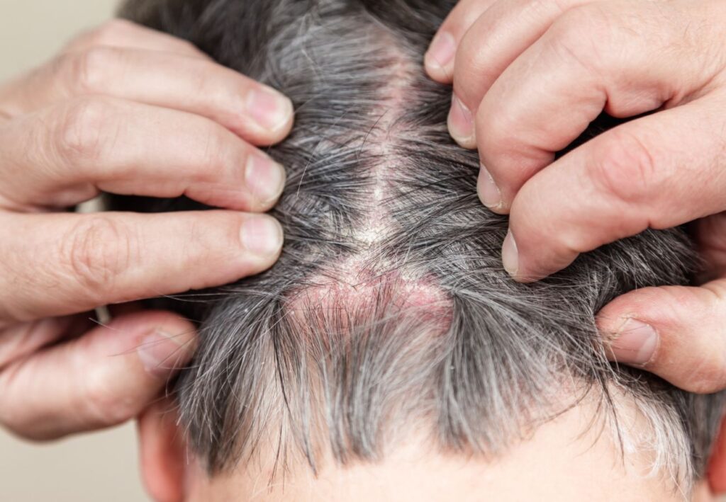 tratamiento psoriasis
