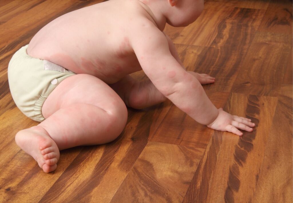 tratamiento urticaria bebés