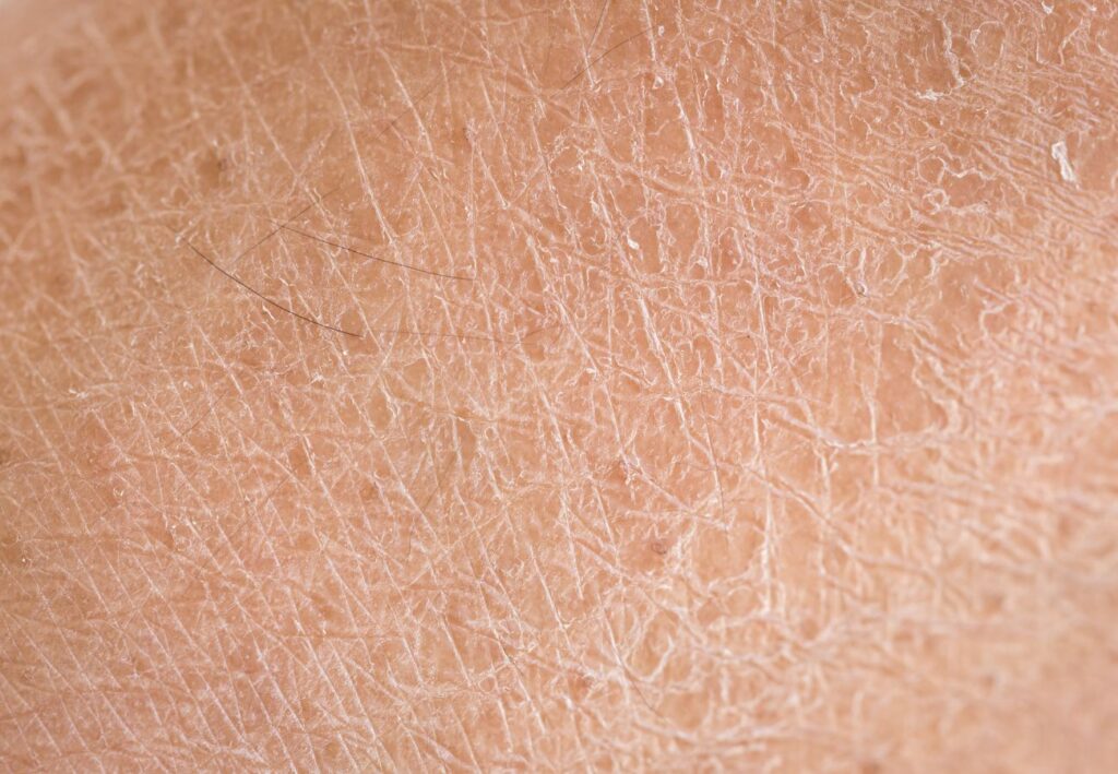 cómo curar eczema