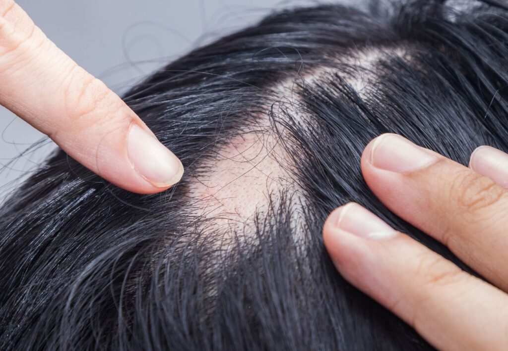 alopecia areata