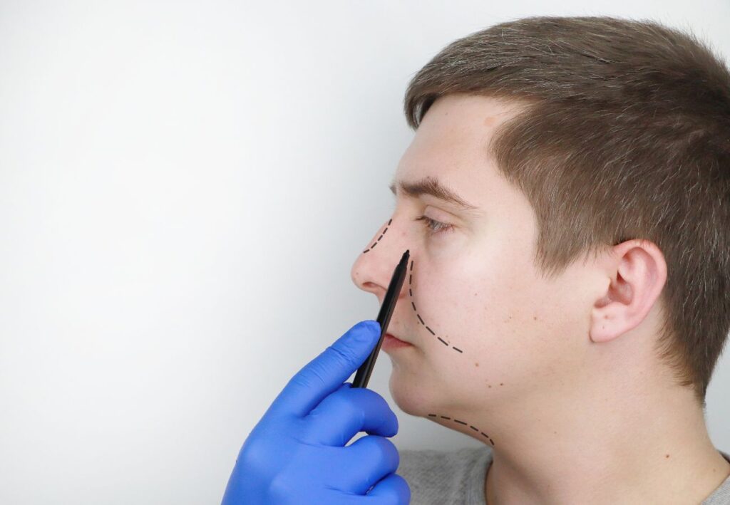 rinoplastia recuperación