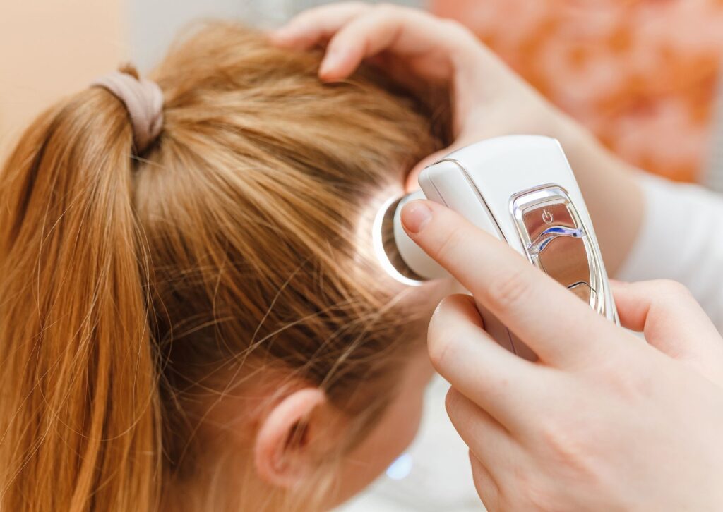 alopecia